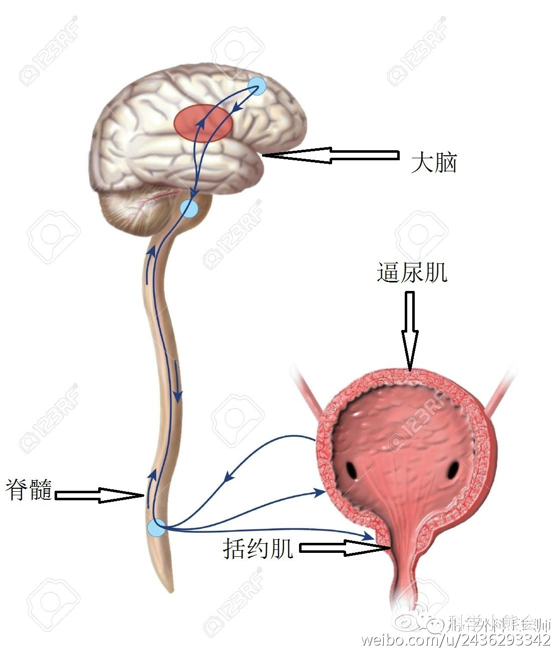 兒童神經源性膀胱之一用間歇導尿的優點-先天性脊柱裂脊髓栓系綜合徵